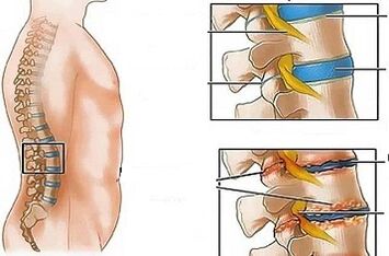 As razões para o desenvolvimento da osteocondrose lombar