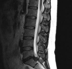 Opções de diagnóstico para osteocondrose lombar