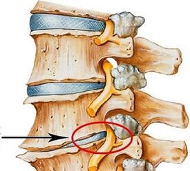 Por que a osteocondrose lombar é