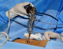 Tratamento cirúrgico da osteocondrose lombar