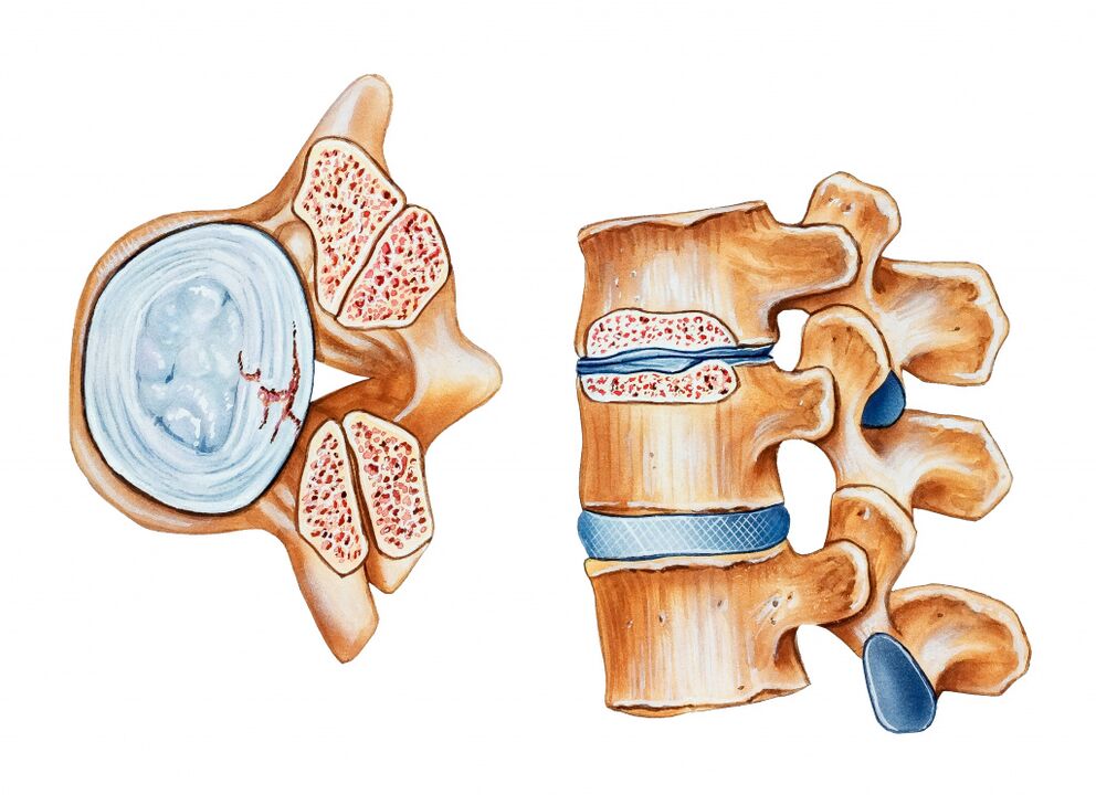 Osteocondrose da região cervical leva à destruição dos discos intervertebrais