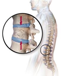 Osteoporose provoca dor nas costas na região lombar